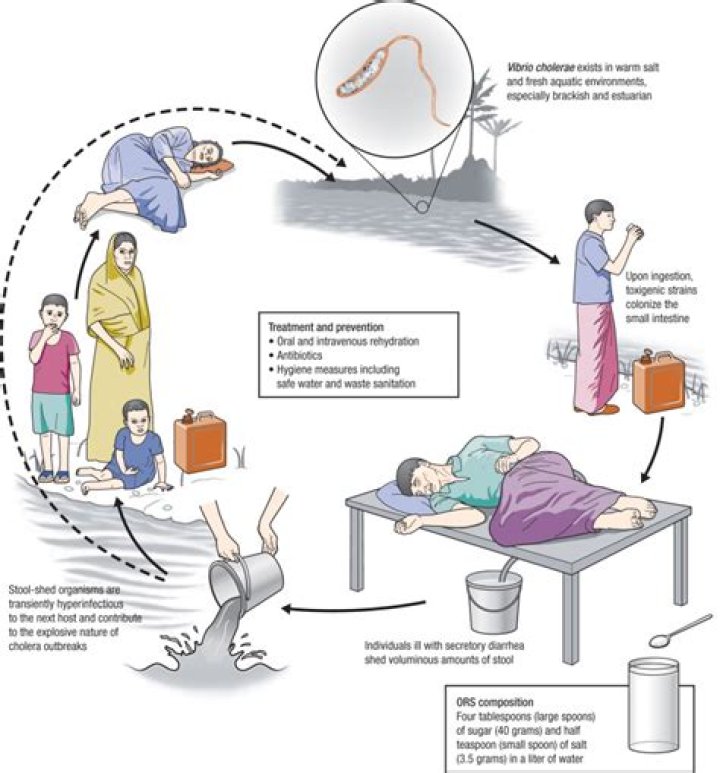 Cholera In Russia: Health Crisis And Prevention
