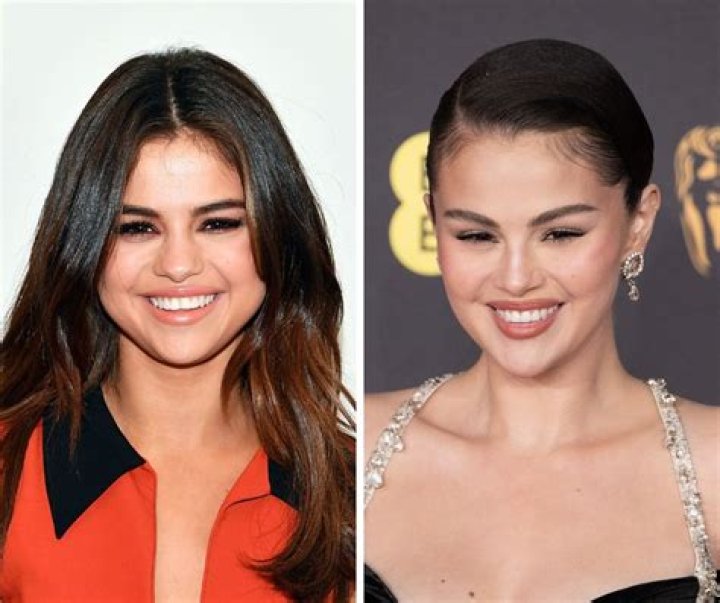 Did Selena Gomez Undergo Vocal Surgery?