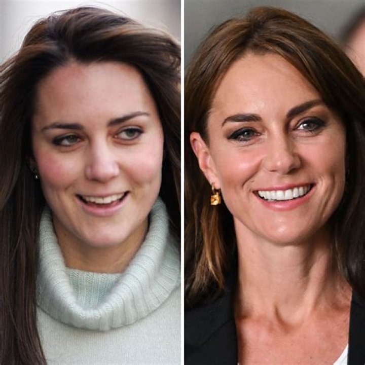 Kate Middleton's Plastic Surgery: A Detailed Look At The Rumors And Facts