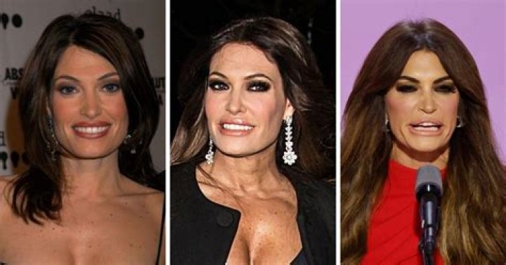 Unveiling The Truth Behind Kim Guilfoyle's Plastic Surgery Journey